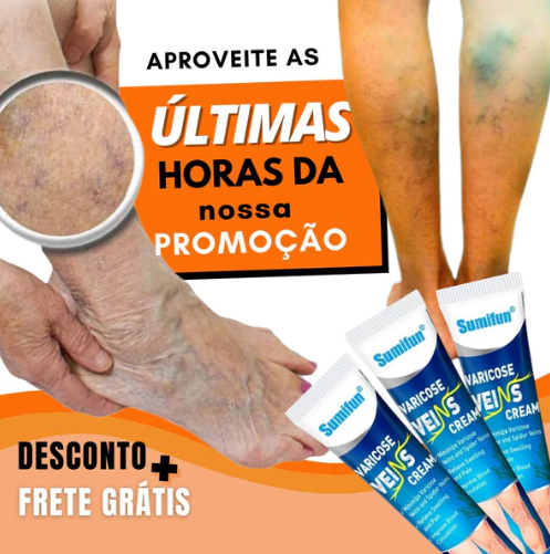 Pomada Varicose Veins - Acabe com as varizes